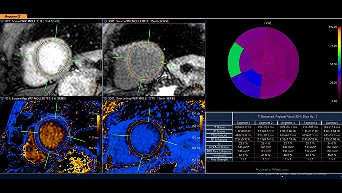 cardiac quantitative mapping thumbnail