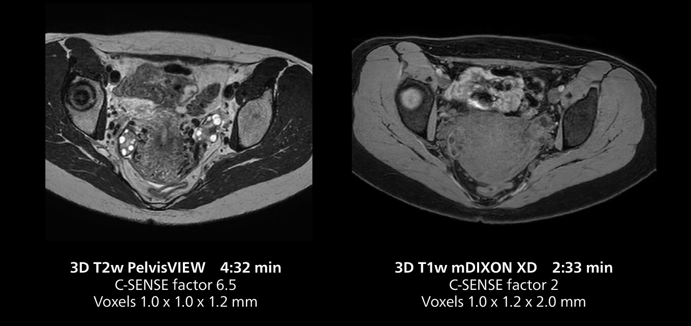 Pelvis mri one