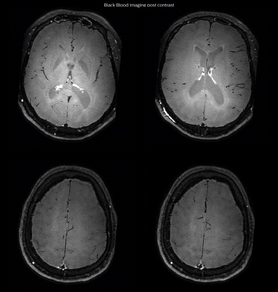 Black Blood Imaging Case 2 Post contrast1