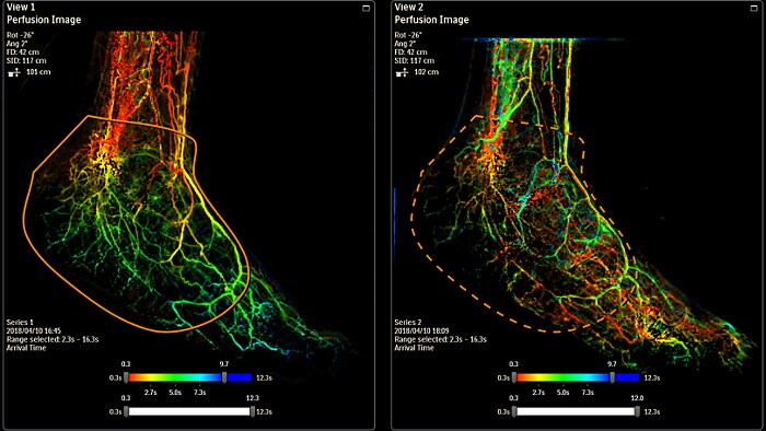 SmartPerfusion foot visualization