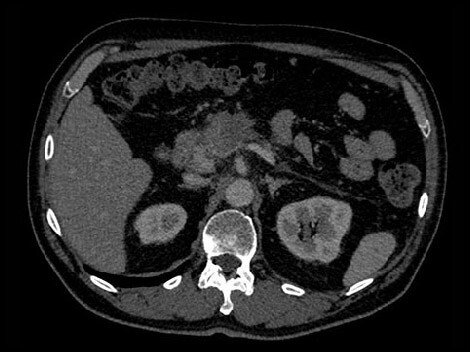 Traditional CT image