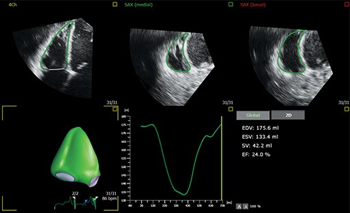 aius study results