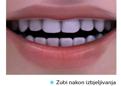 whitening