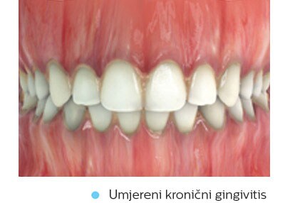 moderate-chronic-gingivitis